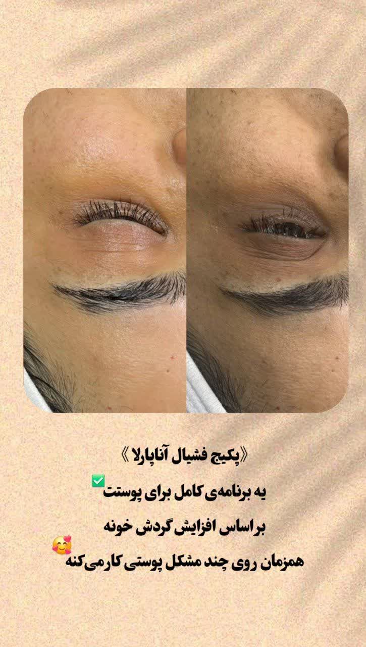 لیفت و لمینت